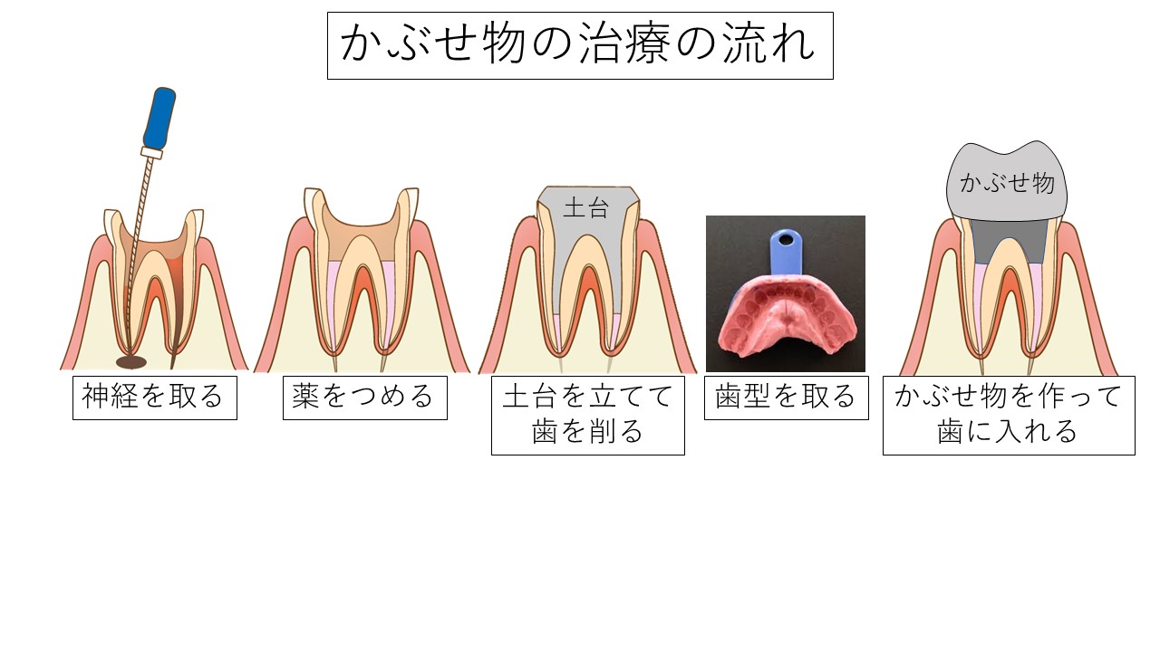 長持ちするかぶせ物、長持ちしないかぶせ物について書きました | ブログ・症例 | 天満・扇町の歯医者ならみつおデンタルクリニック