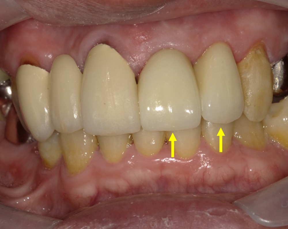 保存が難しい歯を根管治療と矯正治療を行い保存した症例
