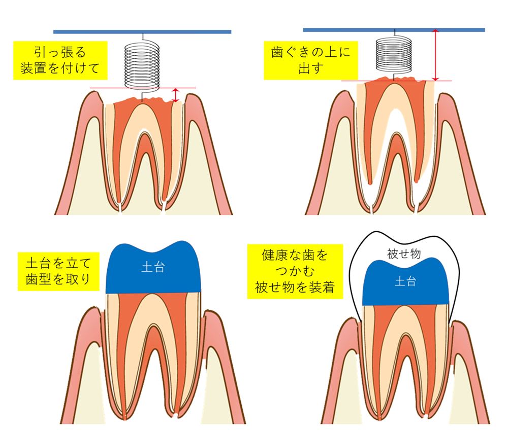 残すことが難しい歯を矯正装置で引っ張り出して、保存した症例