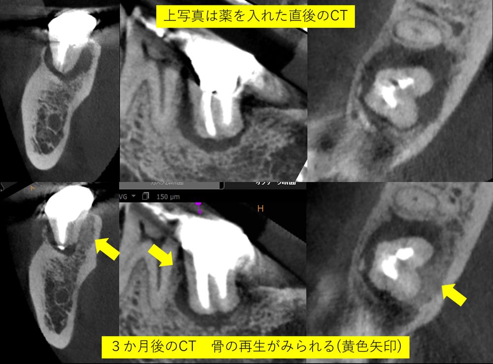 保存が難しい歯をマイクロスコープ(顕微鏡）を用いて精密な根の治療を行い保存した症例