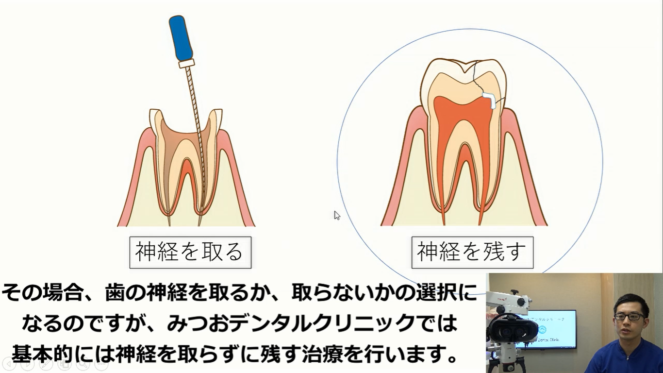 歯の神経を残す治療について動画で説明します