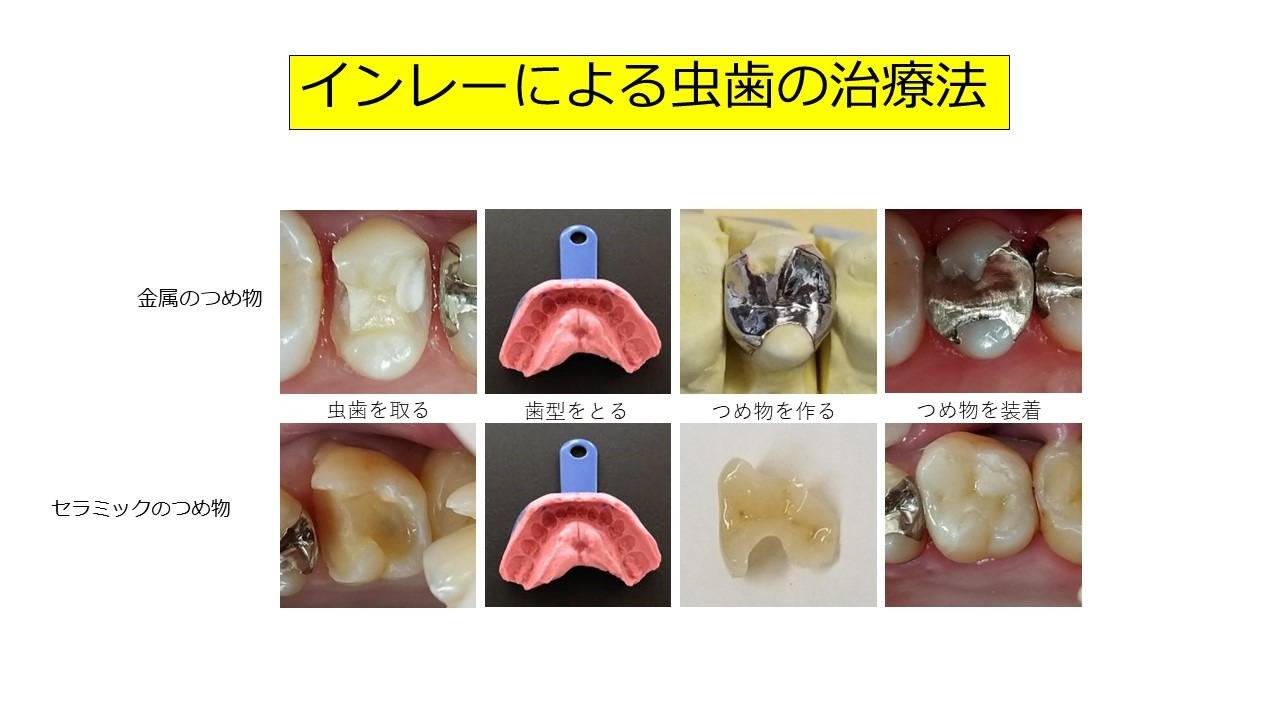 ハーミノス虫歯治療法について