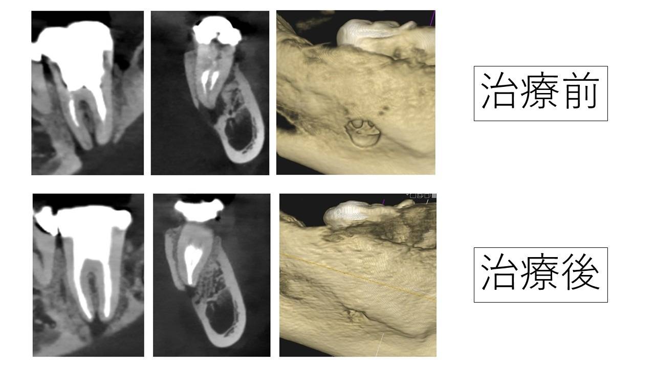 根の大きな病気で骨が溶け穴に。精密な根管治療で骨が再生した症例