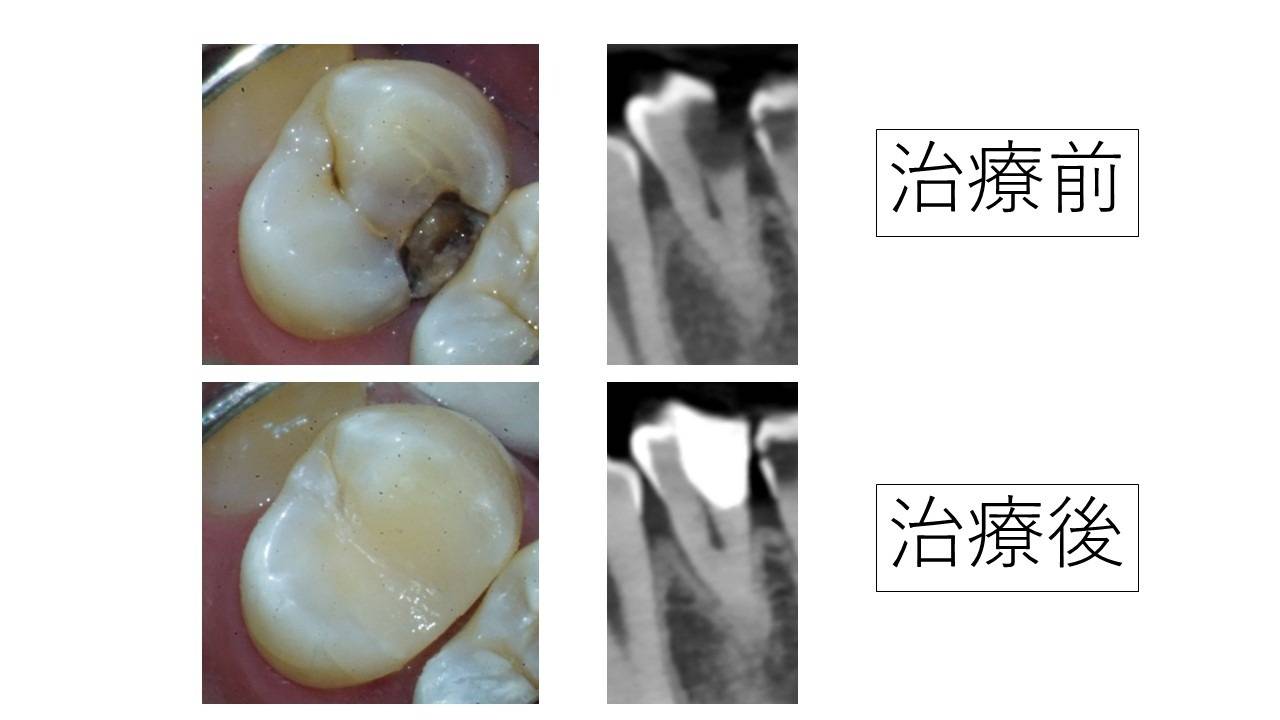 虫歯で穴が空きボロボロ。神経抜いてセラミックと言われた虫歯の治療