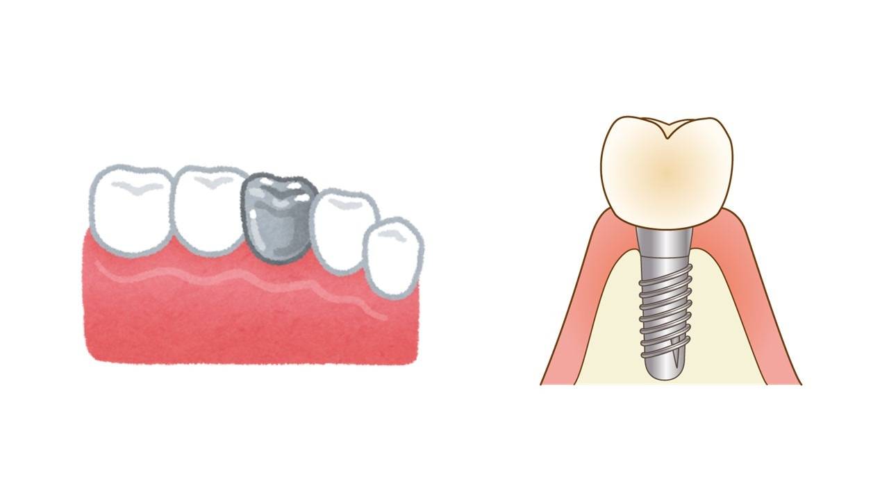 抜いてインプラント。本当にその歯は抜くしかないのか？費用の現実