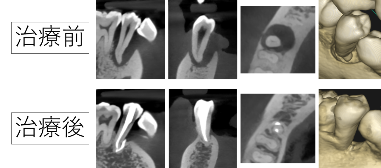 歯が抜ける夢を見る程、歯ぐきが痛くてグラグラ。重度の根と歯周病の治療