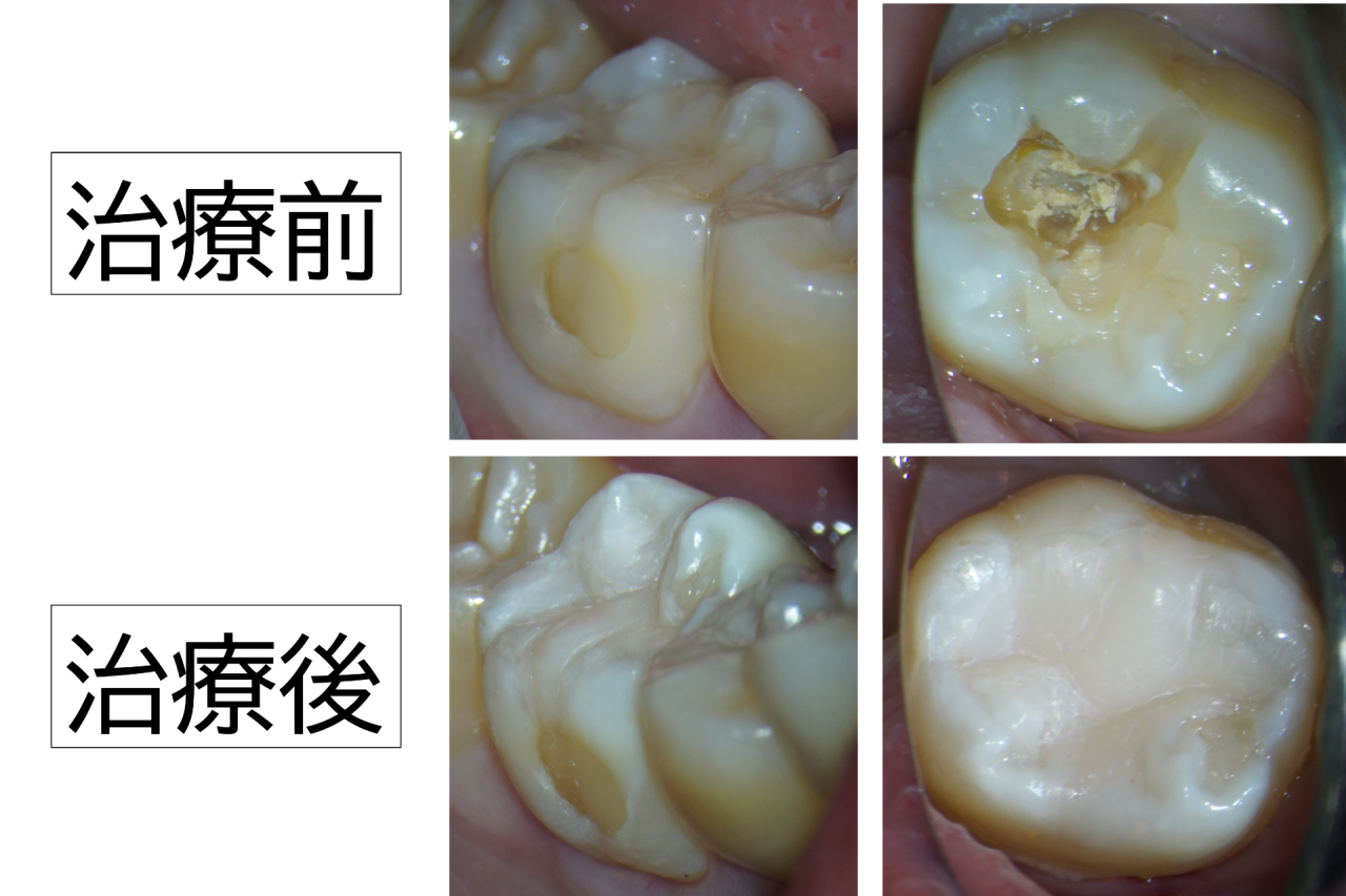 虫歯の取り残しを早期発見。神経を間一髪で残せました