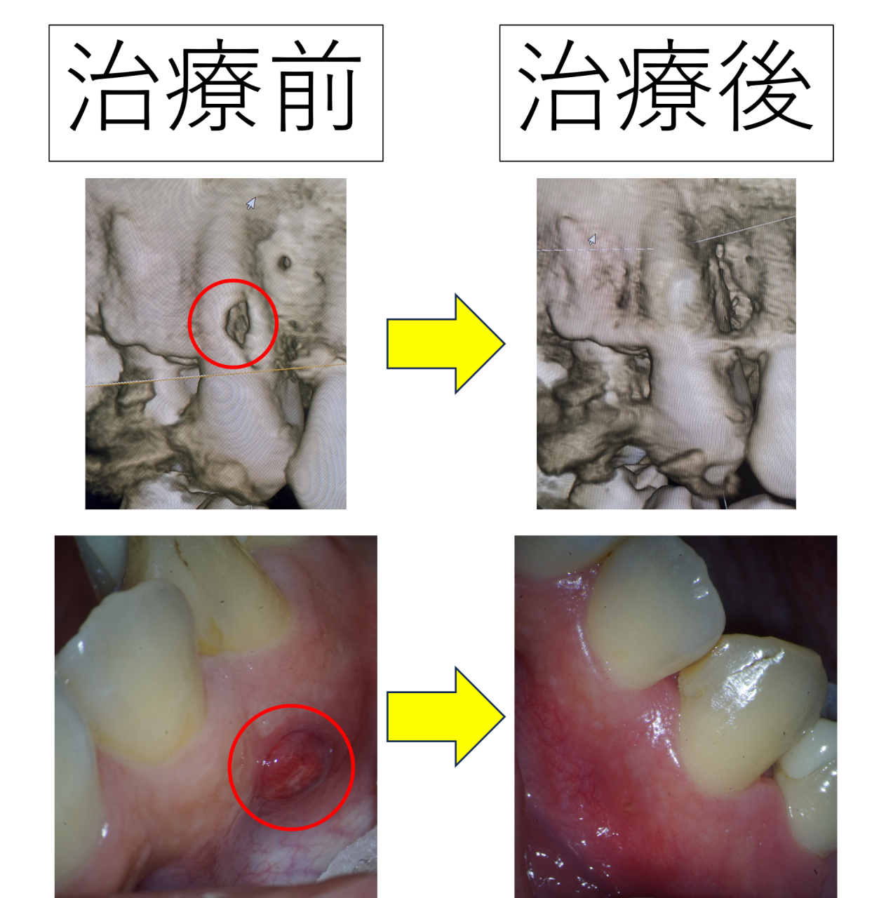【画像あり】歯ぐきに膿とできもの。歯を食べる[外部吸収]を根管治療と歯周病手術で治した難症例
