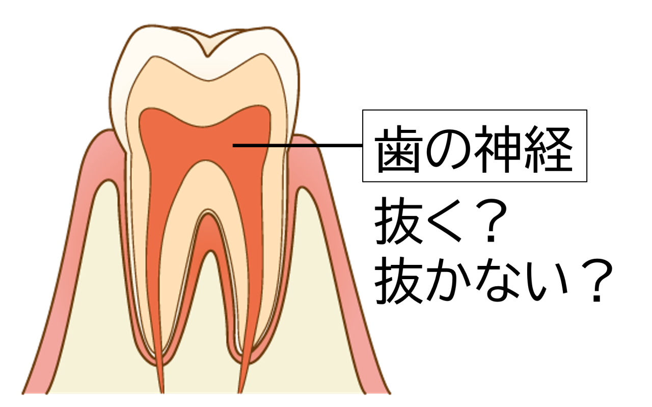 歯の神経を抜くのは必要？院長がわかりやすく説明します