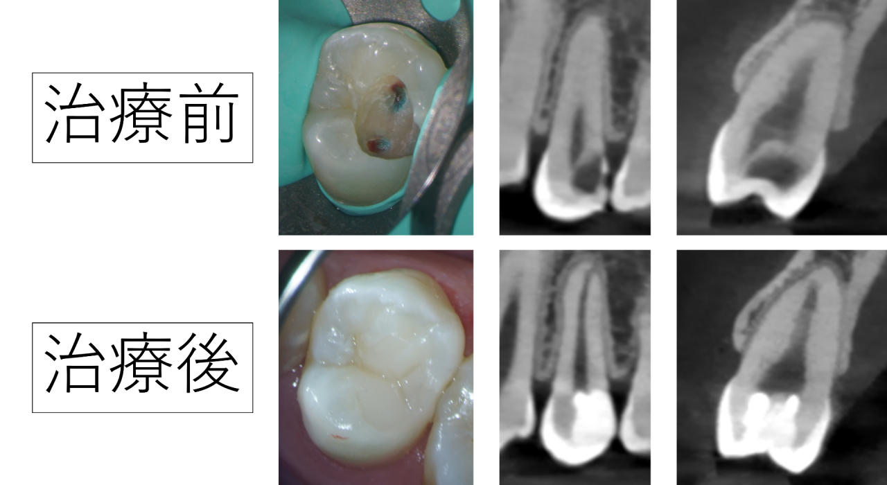 神経を取ると言われた深い虫歯でも神経を残せることがあります｜VPTで神経を残した症例