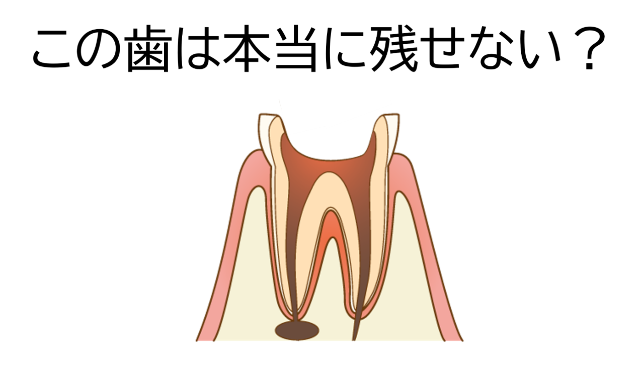 抜歯と言われた歯は本当に残せない？歯医者の専門分野による治療の考え方の違いについて