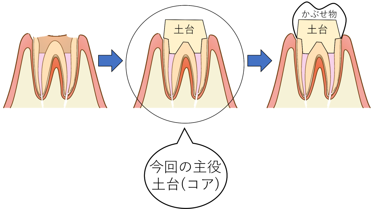 【画像あり】歯の長持ちは、かぶせ物の前に決まる！土台の接着について院長が説明