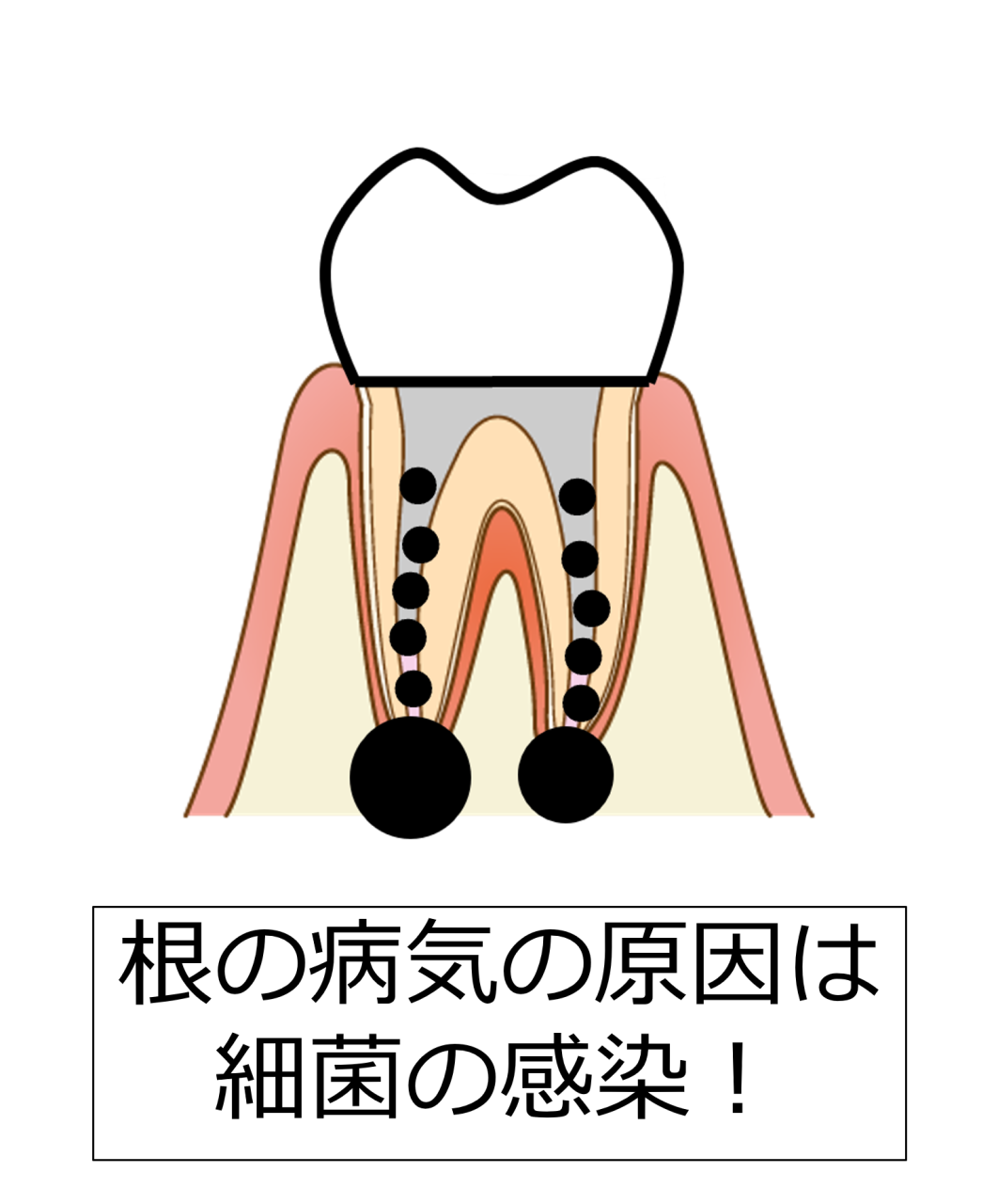 【図説】根の病気の原因は根の中の細菌感染です【根管治療で重要な知識】