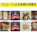 ハーミノス虫歯治療法について