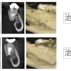 根の大きな病気で骨が溶け穴に。精密な根管治療で骨が再生した症例