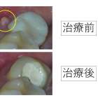 歯にできもの。抜かないといけないと言われた歯を根管治療した症例