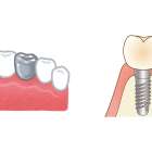 抜いてインプラント。本当にその歯は抜くしかないのか？費用の現実