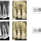 なんとか抜かずに残せた、根の病気と歯周病で顎の骨が大きく溶けた治療