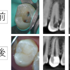 神経を取ると言われた深い虫歯でも神経を残せることがあります｜VPTで神経を残した症例