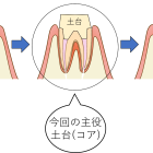 【画像あり】歯の長持ちは、かぶせ物の前に決まる！土台の接着について院長が説明