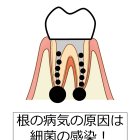 【図説】根の病気の原因は根の中の細菌感染です【根管治療で重要な知識】