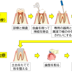 根管治療した歯がまた悪くなるのはなぜ？ 長持ちに関わる根管充填とかぶせ物の話