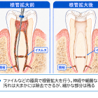 【根管内をピカピカに】強力洗浄の超音波「ピエゾフロー」について