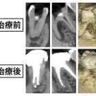 海外で「抜歯」を勧められた歯。原因は非常にまれな神経の取り残しでした