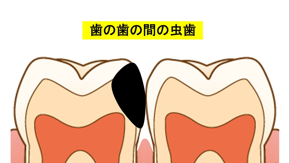 歯と歯の間の虫歯を“長持ちするように”レジンで治す方法について