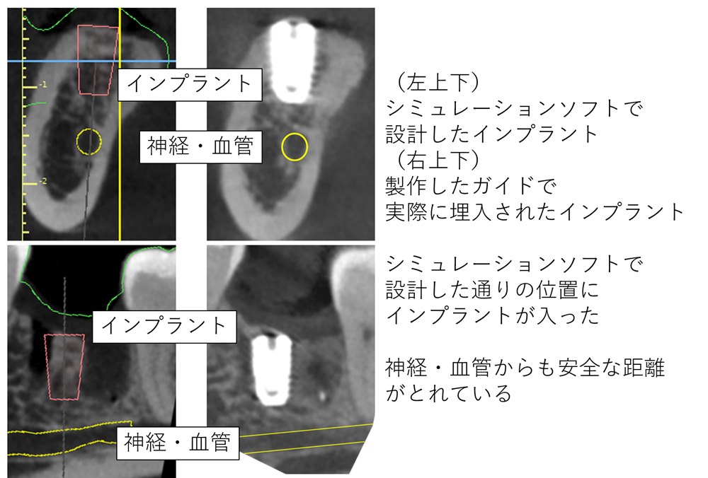 シミュレーションソフトを用いた、安全なインプラント治療について