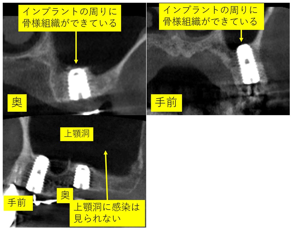 骨が足らない時のインプラント：ガイドとソケットリフトを用いたインプラント治療について