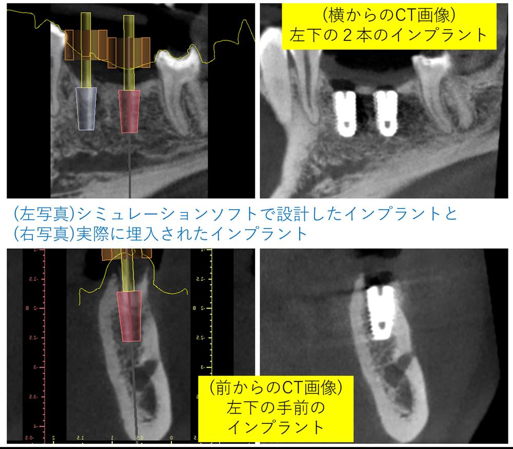 残った歯を守るためにインプラントを行う：ガイドを用いた安全なインプラント治療について