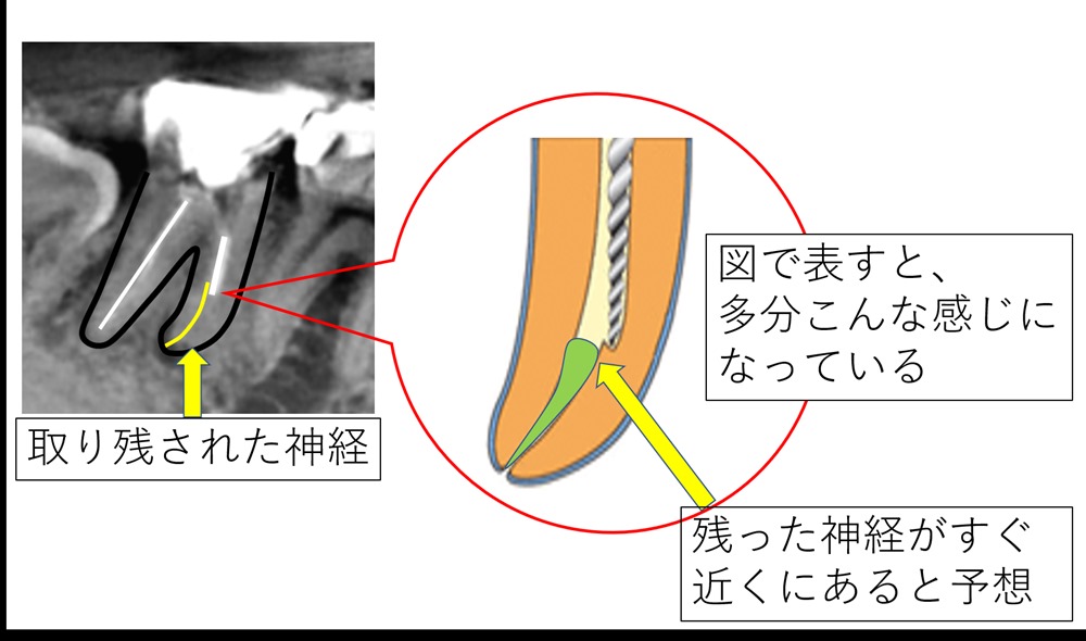 残すことが難しい根の病気を顕微鏡(マイクロスコープ)を用いて治療した症例