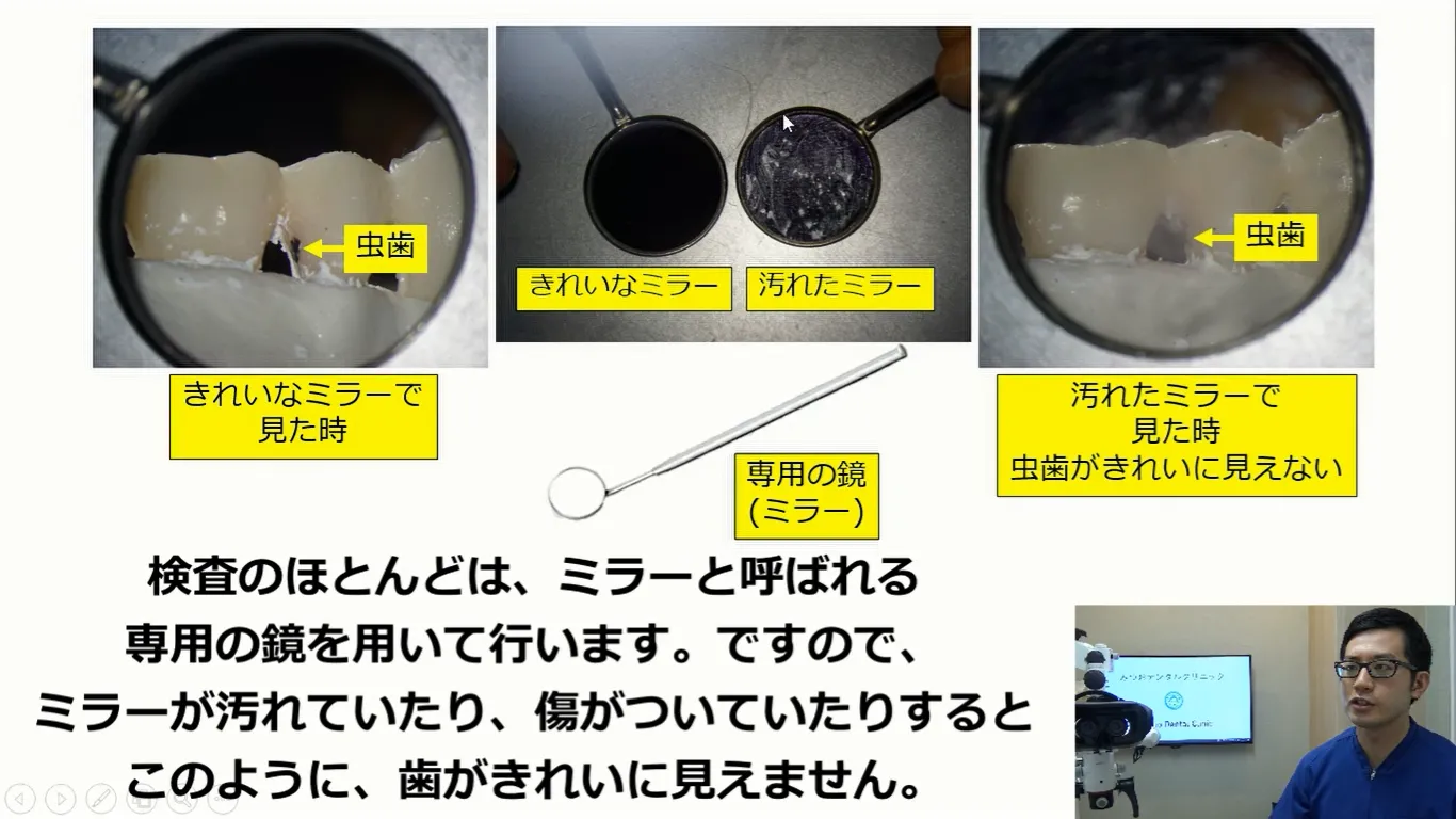 虫歯の見落とし・見間違えをなくす、私の精密な虫歯検査の方法をお教えします。