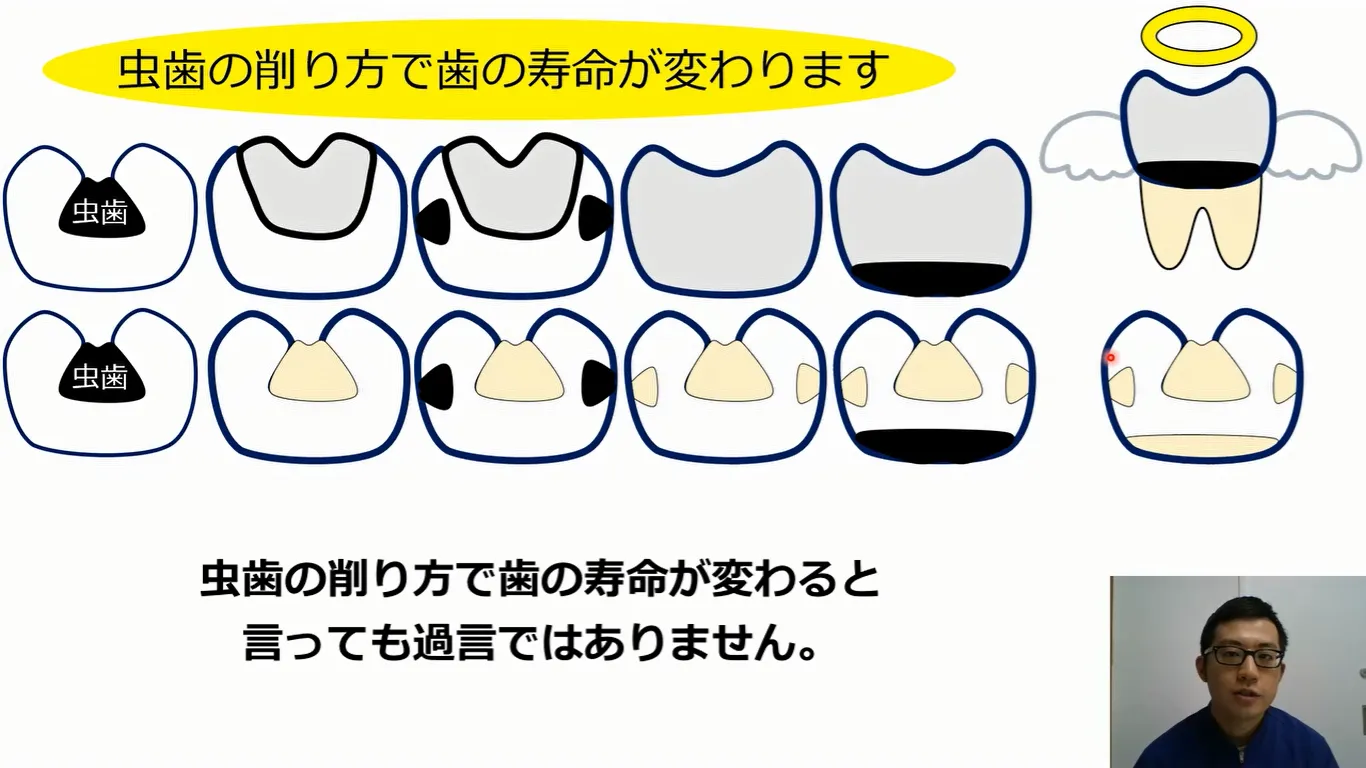 とても大きな虫歯治療。削り方で寿命が決まります。神経を残して治せました。