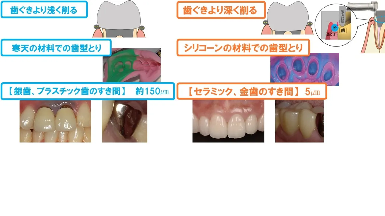 長持ちするかぶせ物、長持ちしないかぶせ物について