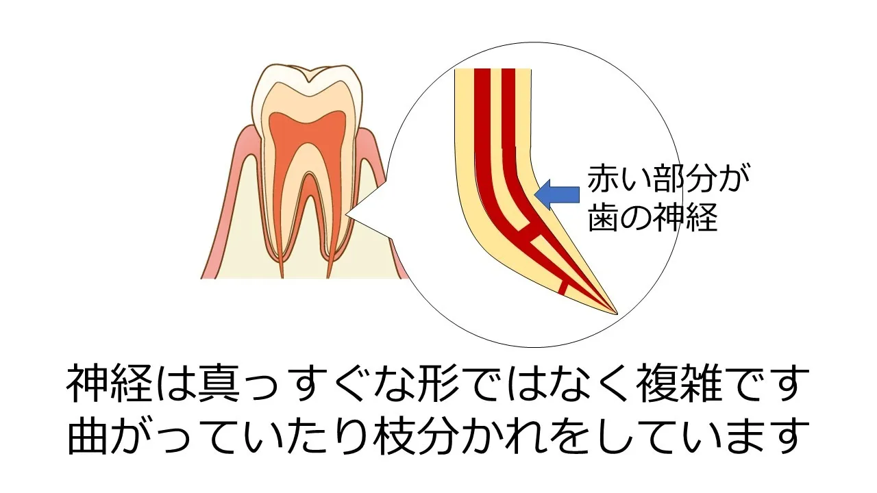 歯の神経は複雑な形をしている図解