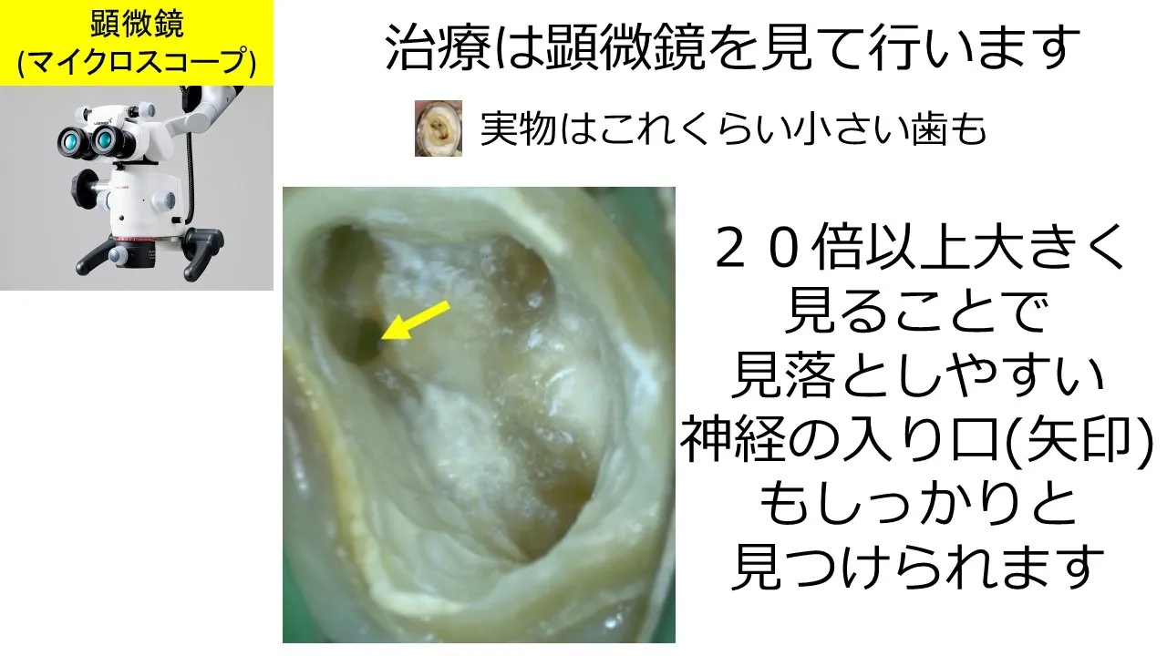 マイクロスコープで拡大した根管内部