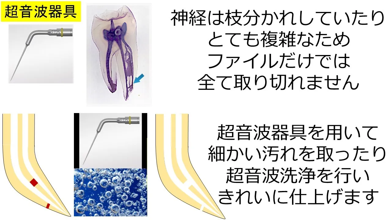 超音波洗浄器具