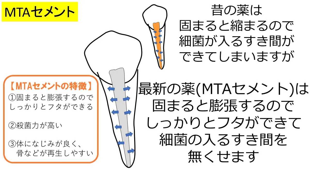 MTAセメントの模式図