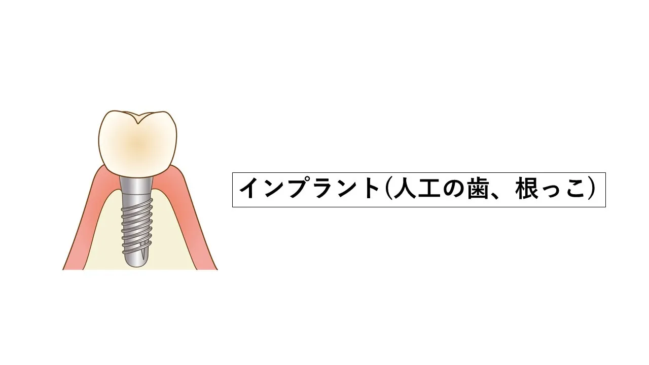 安心安全なインプラント治療について