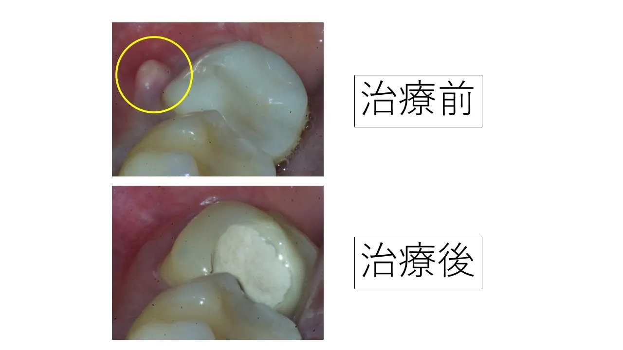 歯にできもの。抜かないといけないと言われた歯を根管治療した症例