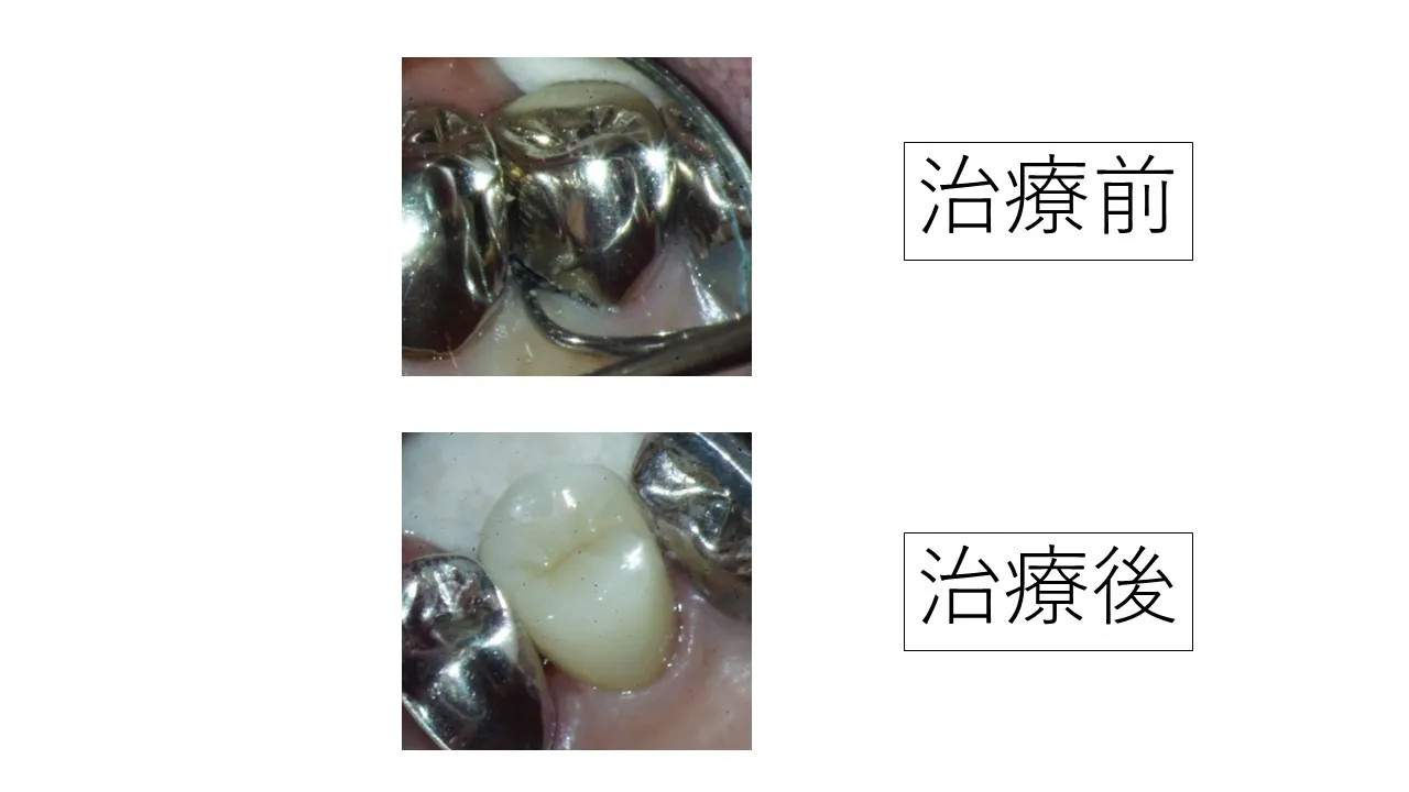 精密検査で発見。虫歯の銀歯を抜かずにセラミックのかぶせ物をした症例