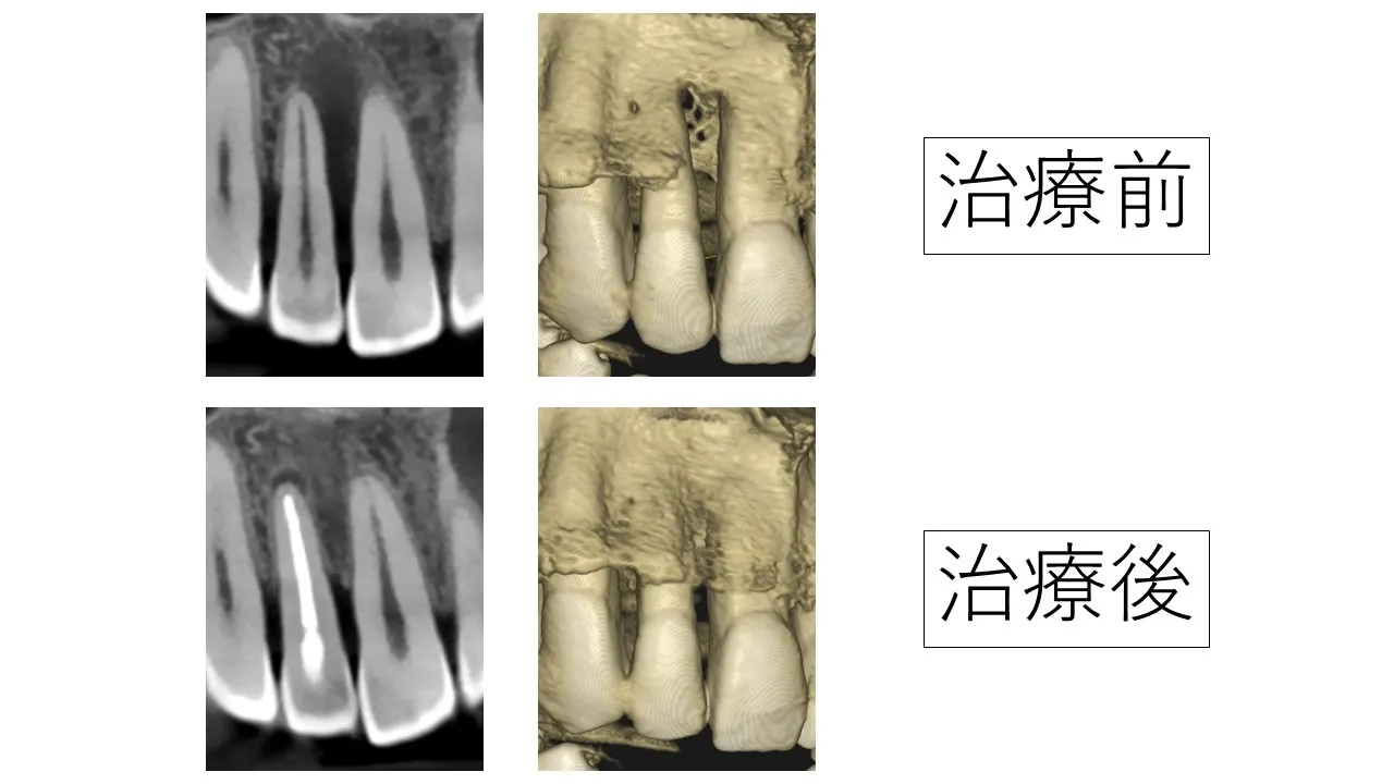 なんとか抜かずに残せた、根の病気と歯周病で顎の骨が大きく溶けた治療