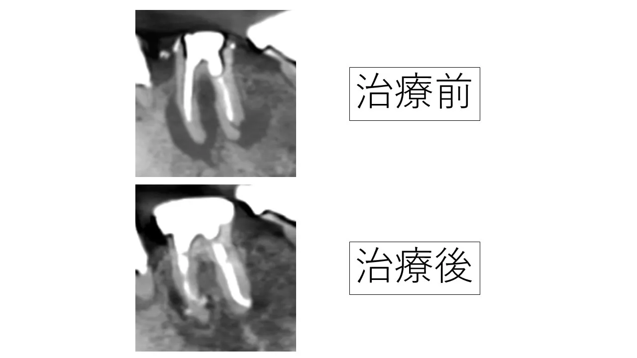 根の病気で顎の骨が大きく溶け、残せないと言われた歯を根の治療で治しました