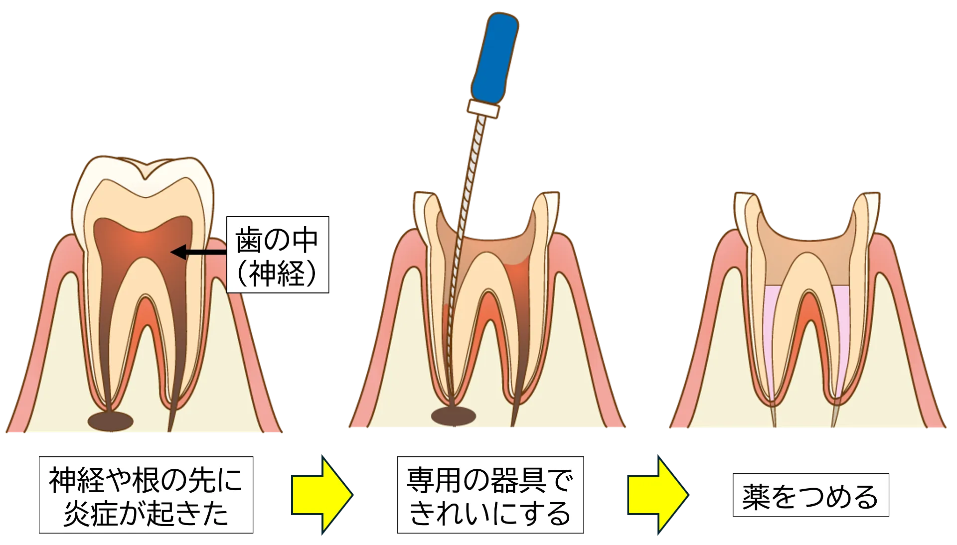 【痛い？】根管治療でよくある質問８つをわかりやすく解説します