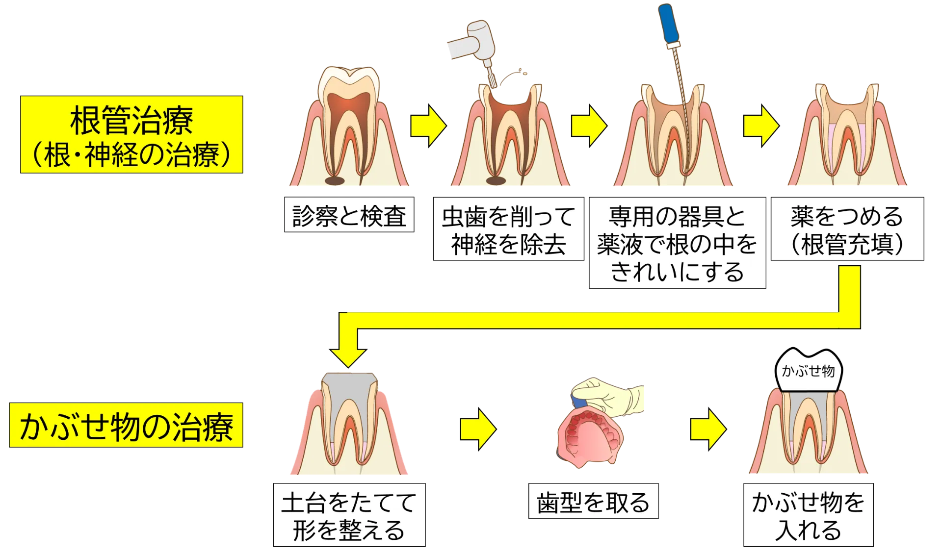 根管治療した歯がまた悪くなるのはなぜ？ 長持ちに関わる根管充填とかぶせ物の話