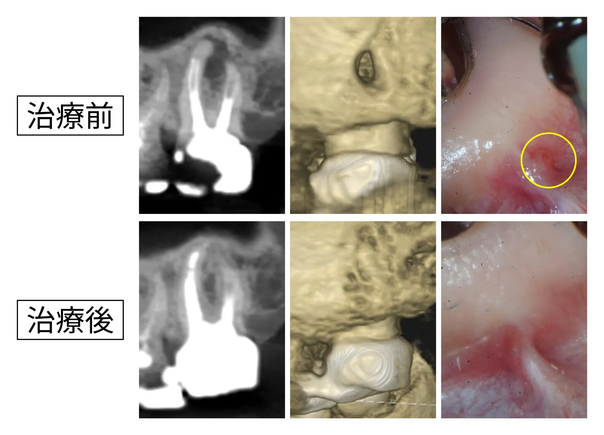 他院で治療できないと言われた左上の奥歯を、 精密根管治療で残せた症例