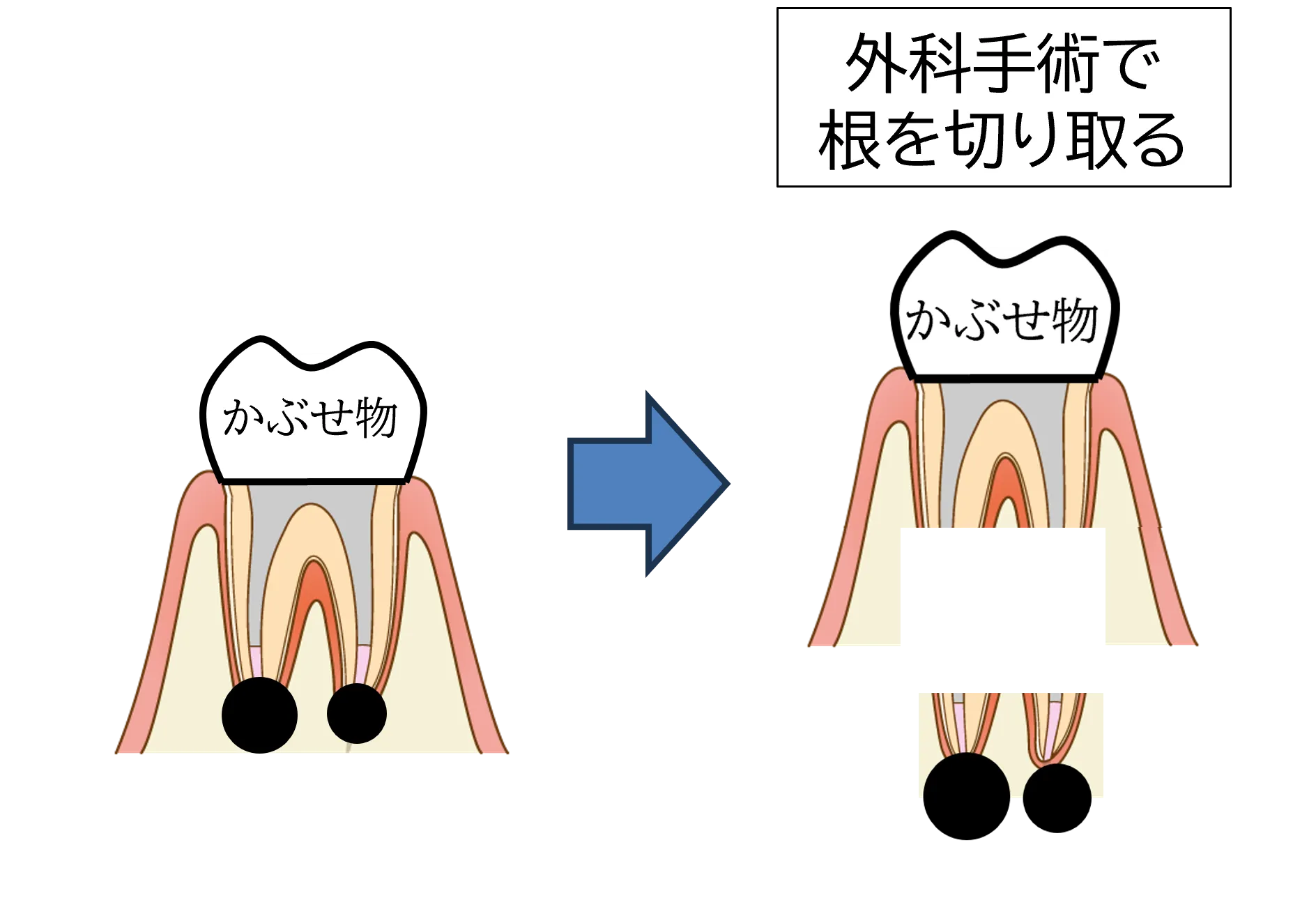 外科手術で根を切り取ることによる根の長さの変化