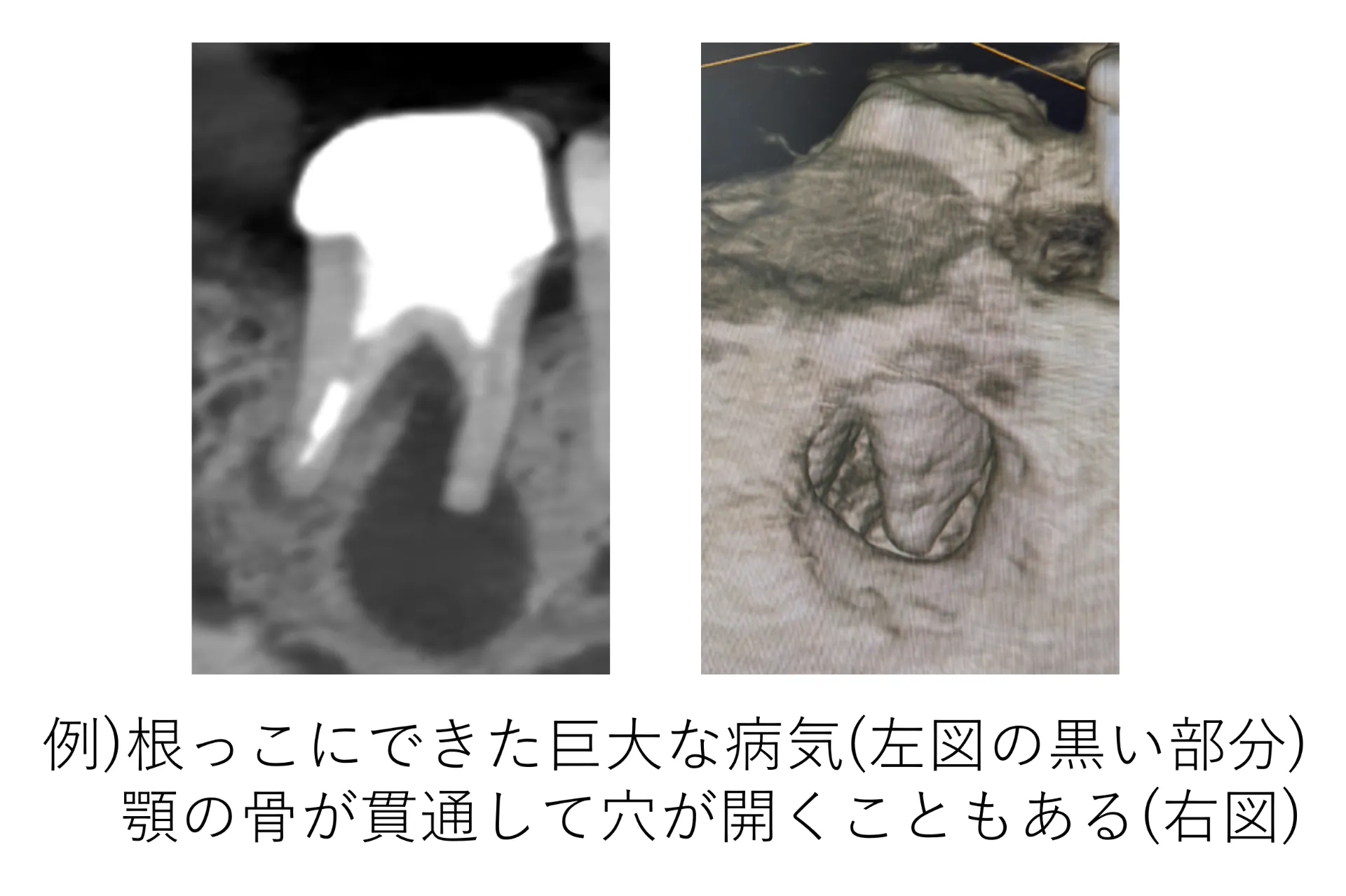 根っこにできた病気のCT画像。顎の骨が貫通して穴が開いている例
